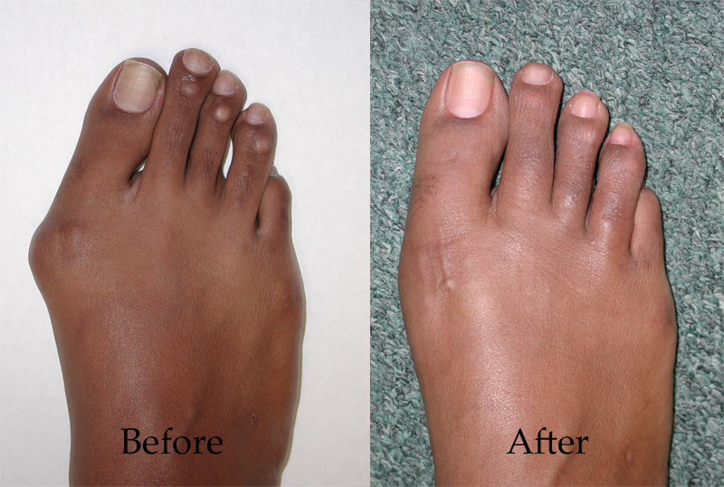 Hammertoe Surgery - Arches Foot Institute Surprise AZ Podiatrist