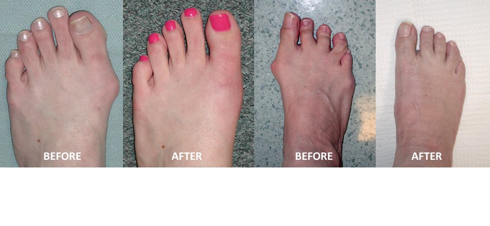 Bunion Surgery